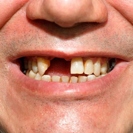 Close up of a man’s smile post tooth-extraction