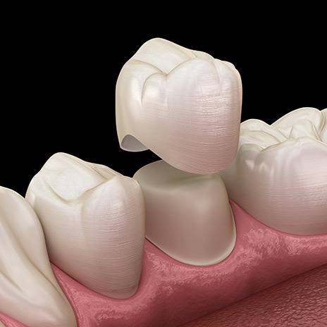 A 3D illustration of a dental crown being placed