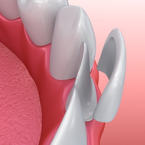 Illustration of veneer being placed on bottom tooth